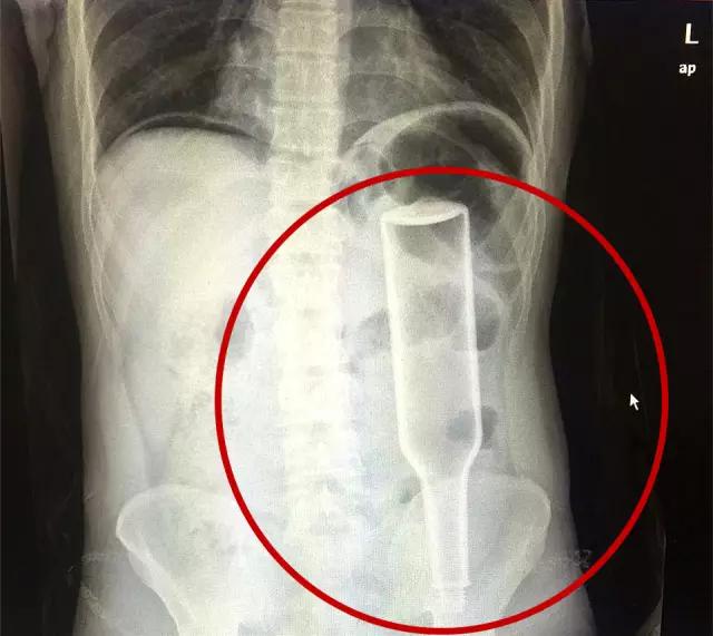 男子将花露水瓶插入肛门，险要其命