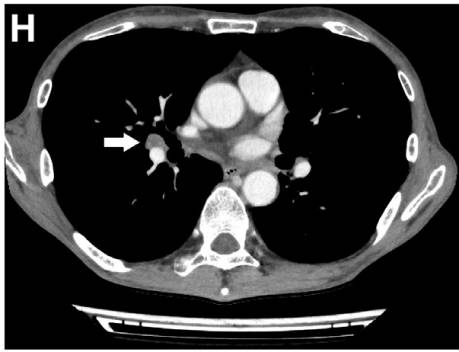 腹泻的不同类型及病例,腹泻的不同原因及现象