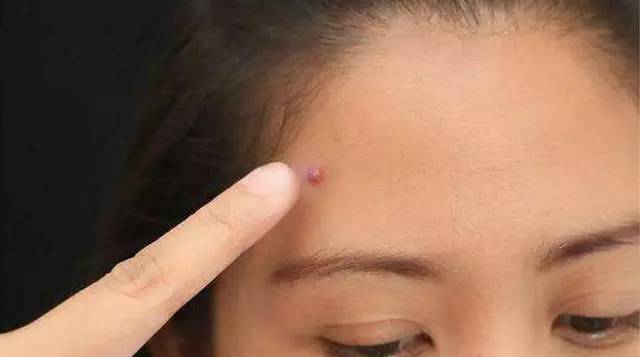 丘疹痘痘的症状和原因,青春期痘痘的症状和治疗方法