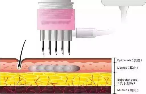 打一针水光针,打一针玻尿酸要1万多