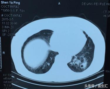 反复发烧咳嗽是否是肺结核,肺结核反复咳嗽怎么回事