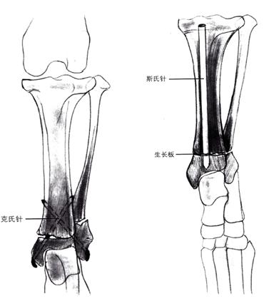 猫前肢肱骨头骨折,猫股骨远端骨折治疗