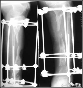 胫骨骨折骨缺损多大可以自愈,胫骨骨折有小块骨缺损影响吗