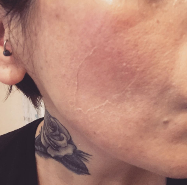 祛痘祛闭口粉刺黑头,如何有效的祛痘去黑头去闭口