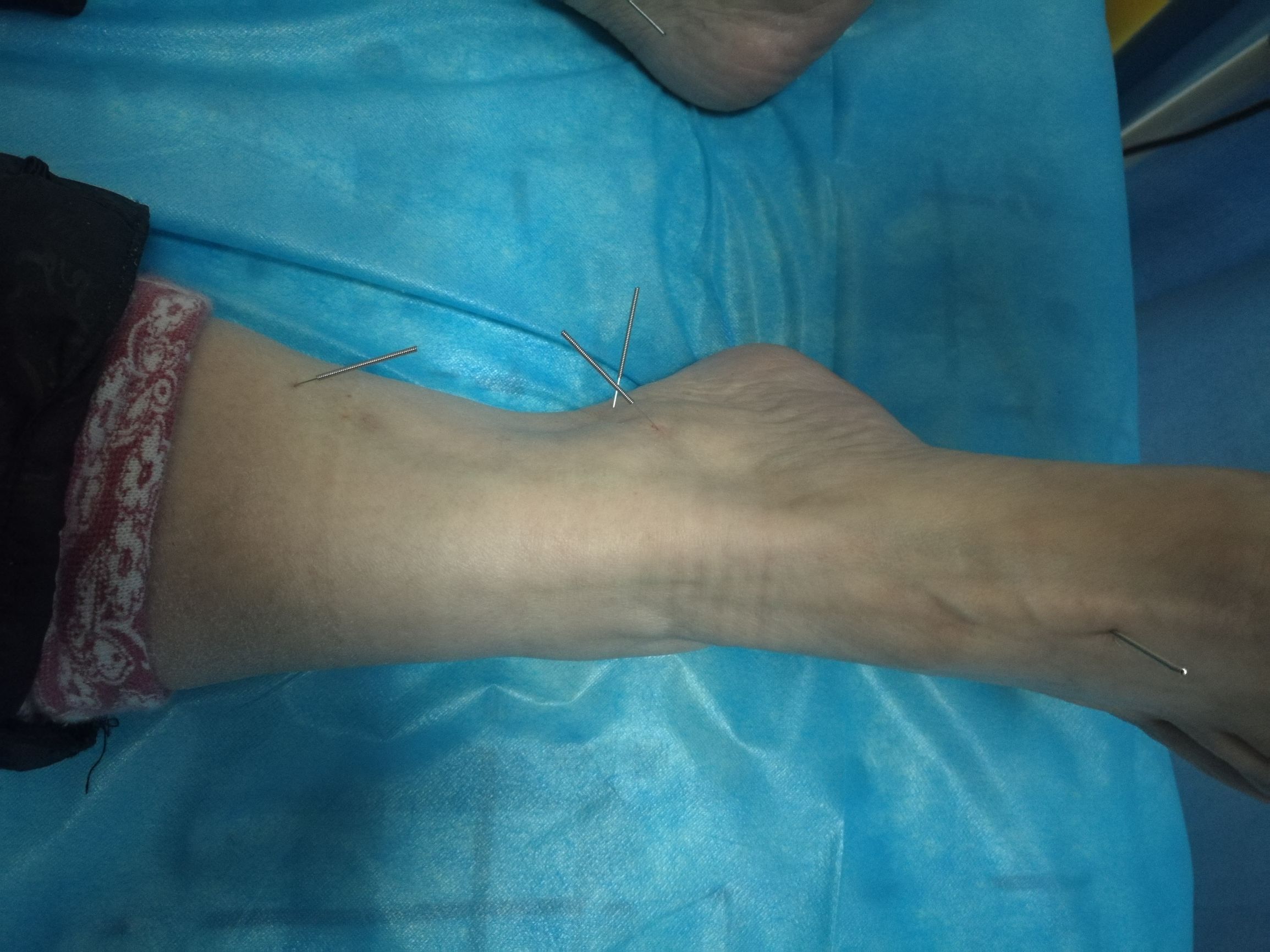 慢性鼻炎需要治疗吗,治疗慢性鼻炎的药物