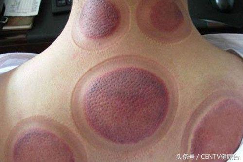 推完背拔完罐后背黑紫是什么原因,拔空气罐后皮肤黑紫原因