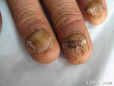 灰指甲要先检验吗,灰指甲需要检查什么项目