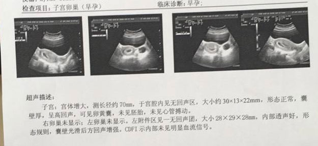 做阴式b超时特别疼,做阴式b超时出血
