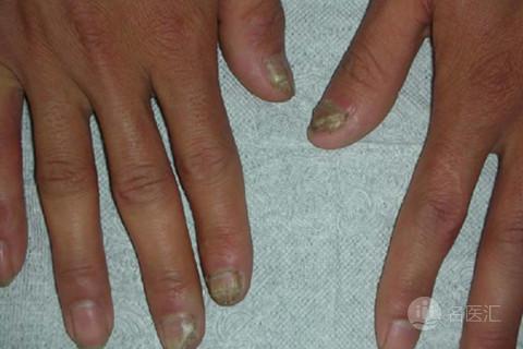 治疗灰指甲的办法及灰指甲的影响