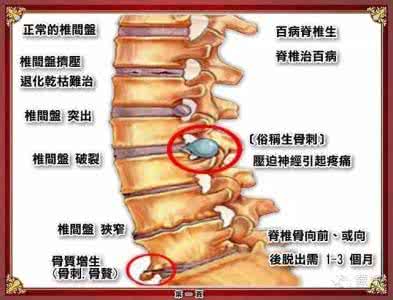 腰椎骨质增生怎么治疗最好得快,中医正骨能治骨质增生吗