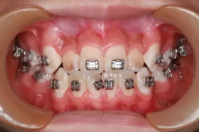 正畸戴牙环疼怎么办,正畸牙套戴不上了怎么办