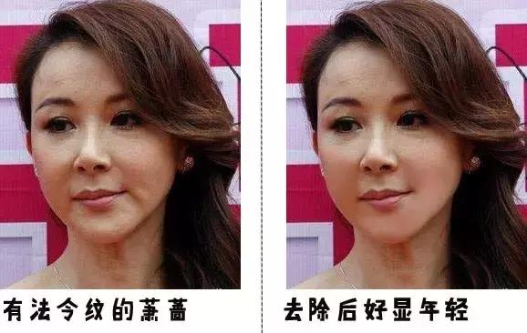 听说爱笑的女孩子法令纹都很深,爱笑的女孩真的容易得法令纹吗