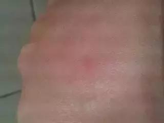 被猫狗咬伤没出血,被狗咬出血了一定要打狂犬疫苗吗