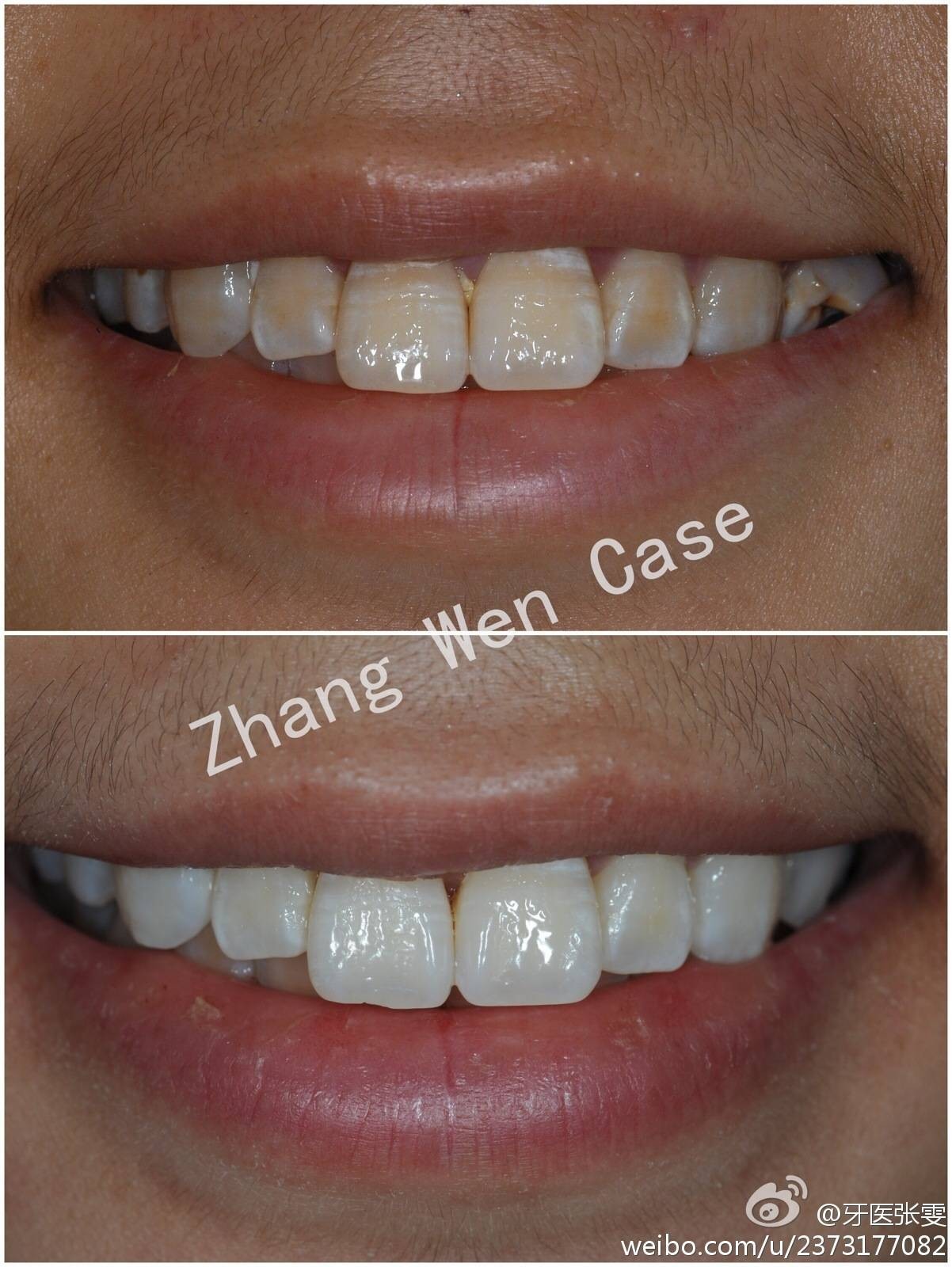 牙齿美白损伤最少的方法,想要牙齿美白这三招最管用