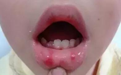 小孩疱疹性咽峡炎怎么预防,疱疹性咽峡炎高发季节
