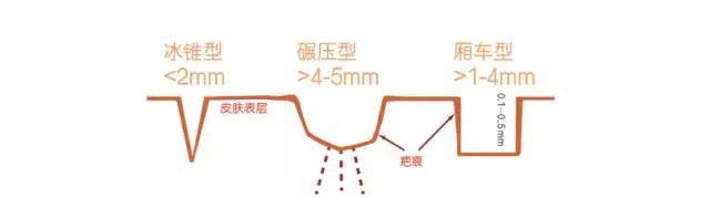治疗痘印痘坑毛孔粗大的药,男士毛孔粗大痘坑痘印修复