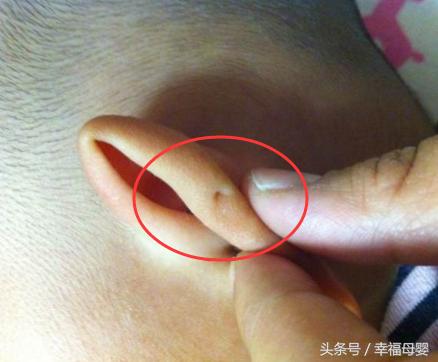 宝宝耳朵内侧有个小针眼洞,两个月的宝宝左耳耳前瘘管