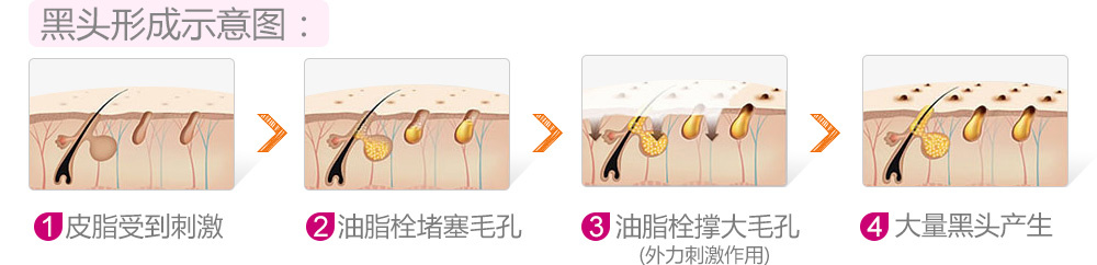 鼻子两边脸上毛孔粗大有白色东西,额头鼻子脸颊毛孔粗大有黑头咋办