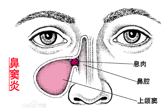 鸡呼吸道疾病用药,急性上呼吸道感染细菌感染用药