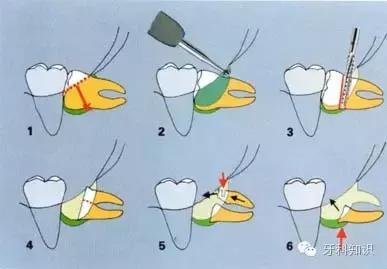 口腔拔牙图片,口腔拔牙麻醉多久消退