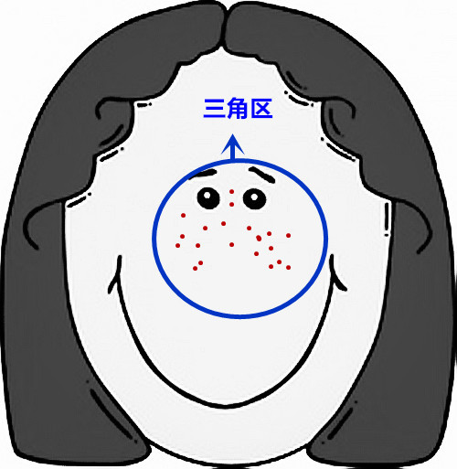 面部痘痘的症状图片和讲解,面部痘痘原因分析图片
