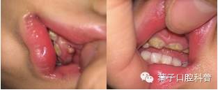 牙龈长脓包了吃什么药好,牙龈肿个大脓包吃药可以消掉么