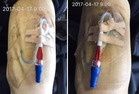 敷料致接触性皮炎，护士这样换药处理，效果极佳！