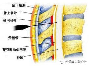 椎管内麻醉引起的头痛该怎么处理,椎管内麻醉头痛部位
