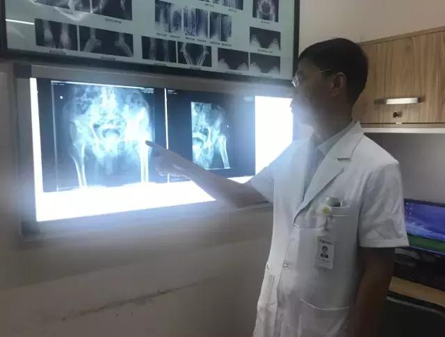 老人胯部粉碎性骨折,老人胯骨骨折最佳手术时间