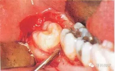 口腔拔牙图片,口腔拔牙麻醉多久消退