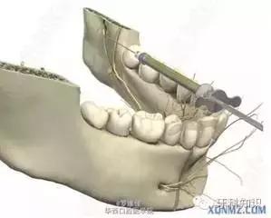 口腔拔牙图片,口腔拔牙麻醉多久消退