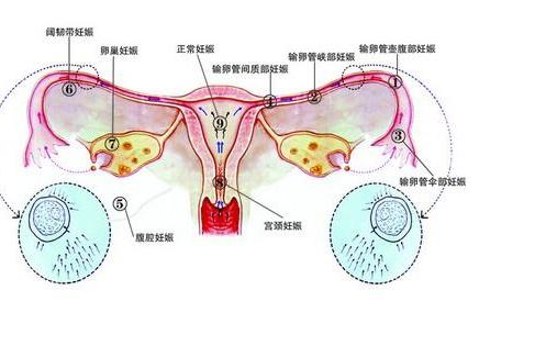 宫外孕是什么？怎样才能避免？