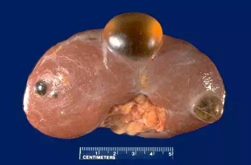 肾脏长了个囊肿怎么办,肾脏长了个囊肿应注意什么