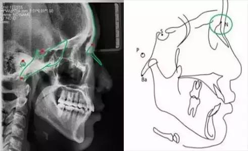 正畸头影测量中的y轴怎么测,正畸投影测量基础讲解