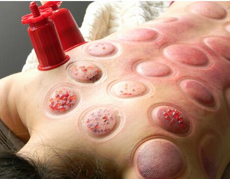 湿气重拔罐多久祛除湿气,湿气重拔罐能解决湿气吗