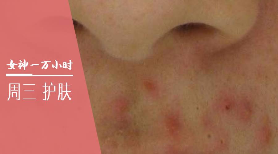 痘痘一直治不好的根本原因,痘痘是痤疮还是毛囊炎怎么判断