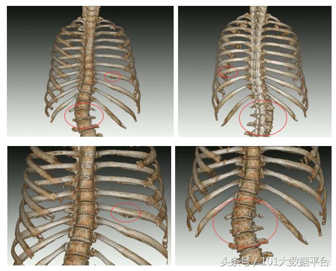 多模式VR重建+精准术前评估，博为三维重建成张家口市第二医院临床骨科精准诊疗的强大工具