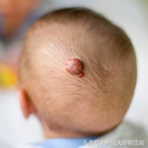 宝宝胎记为何“同记不同命”是因为你陷入了这几个误区