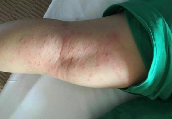 小孩螨虫叮咬最快消除方法,宝宝身上螨虫红疹子怎么治