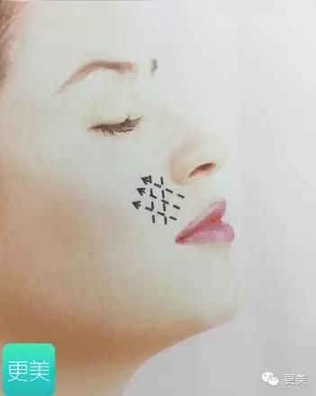 脸部缝美容线好还是普通线好,医院埋线和美容院埋线有什么差别