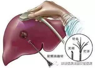 冷冻消融微创手术治肿瘤,柳叶刀肿瘤消融治疗