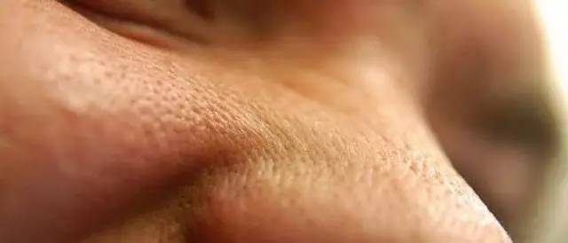 十年战痘血泪史详解,战痘知识分享