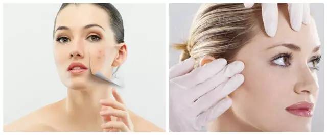 战痘合集完整版,战痘大结局完整版