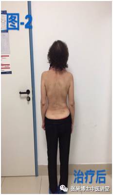 小针刀治疗脊柱侧弯,腰椎间盘突出脊柱侧弯的针刀治疗