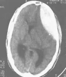 慢性硬膜下血肿手术后复查ct,硬膜下血肿ct值68hu是什么意思