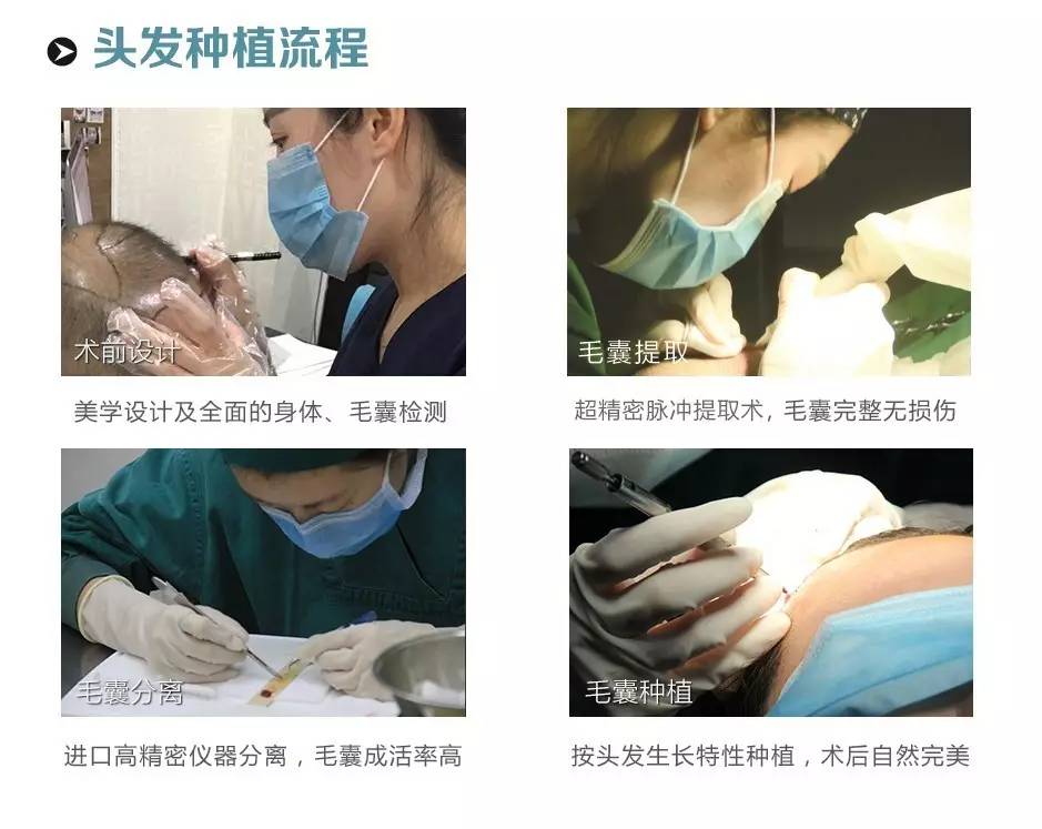 严重脱发秃顶发际线后移如何改善,长期熬夜导致发际线后移秃顶脱发