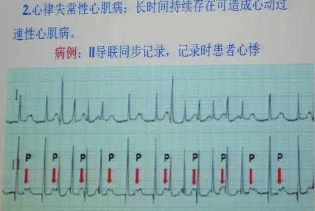 郭继鸿心电图学教程,郭继鸿异常心电图