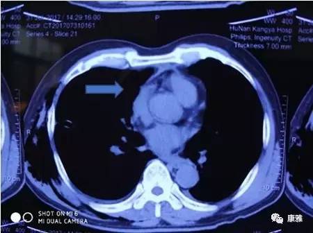 胸腔镜微创能切除多大的肿瘤,胸腔镜切除肿瘤