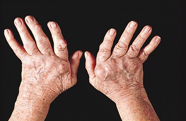 爸妈说你“二天”一定要得的这种病，到底是个啥子病？