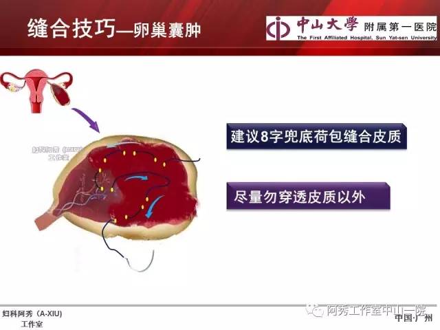 妇科腹腔镜下常用缝合技巧